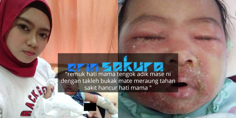 Anak Kulit Bersisik, Mata Bengkak Akibat Sentuhan Orang 