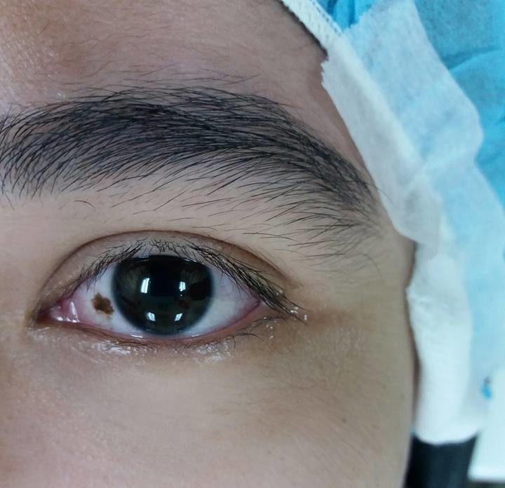 Ramai Anggap Tahi Lalat Mata Benda Normal, Doktor Dedah Rupanya Petanda Kanser