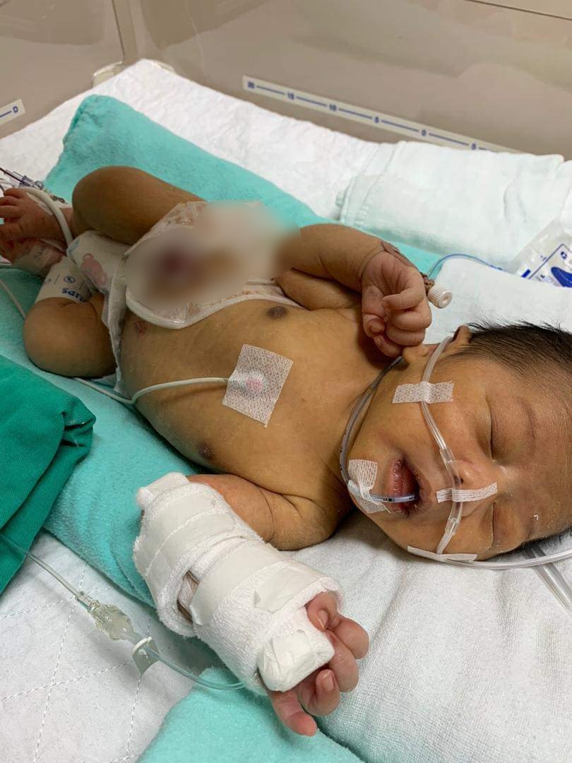 Baby Tanggung ‘Rare Disease’, Tak Dapat Minum Susu Hingga Badan Tinggal Tulang