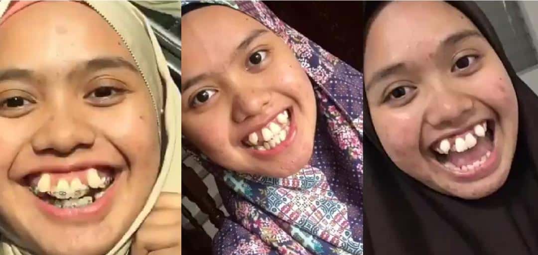 Pernah Diejek Gigi Salah ‘Parking’, Gadis Sanggup Berhabis RM6K Demi Penampilan