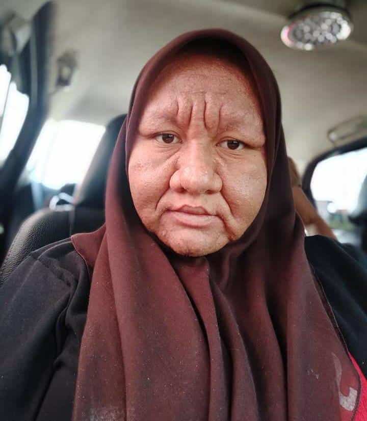 Wajah Bengkak & Kedut Seakan Orang Tua, Wanita Alami Alahan Teruk Semasa Hamil