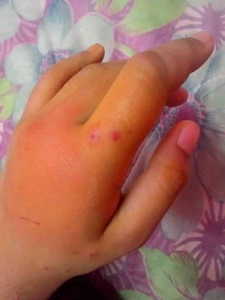 2 Kali Jalani Operation, Gadis Dedah Pengalaman Ngeri Digigit Kucing Kesayangan
