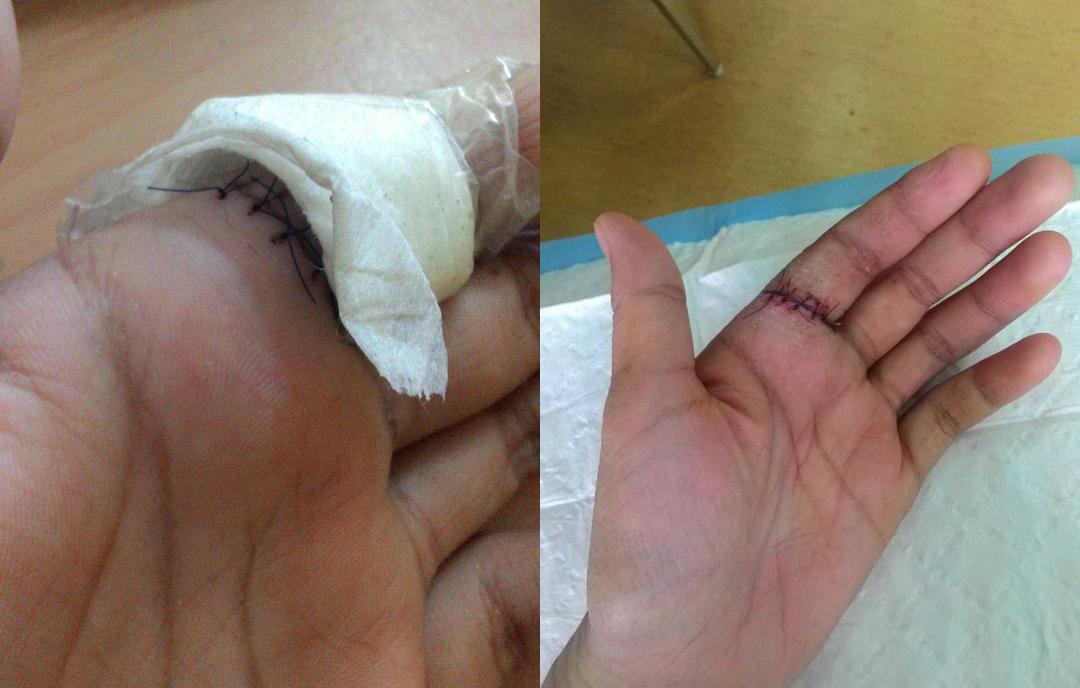 2 Kali Jalani Operation, Gadis Dedah Pengalaman Ngeri Digigit Kucing Kesayangan