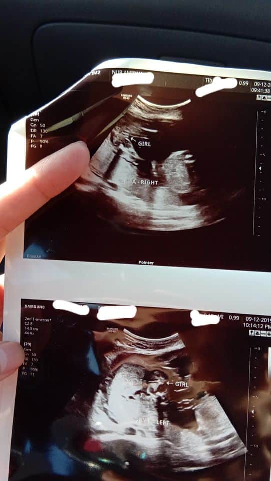 2 Hari Lagi Nak Sambut Baby Kembar, Tapi Allah Uji ‘Ambil’ Semula Serentak