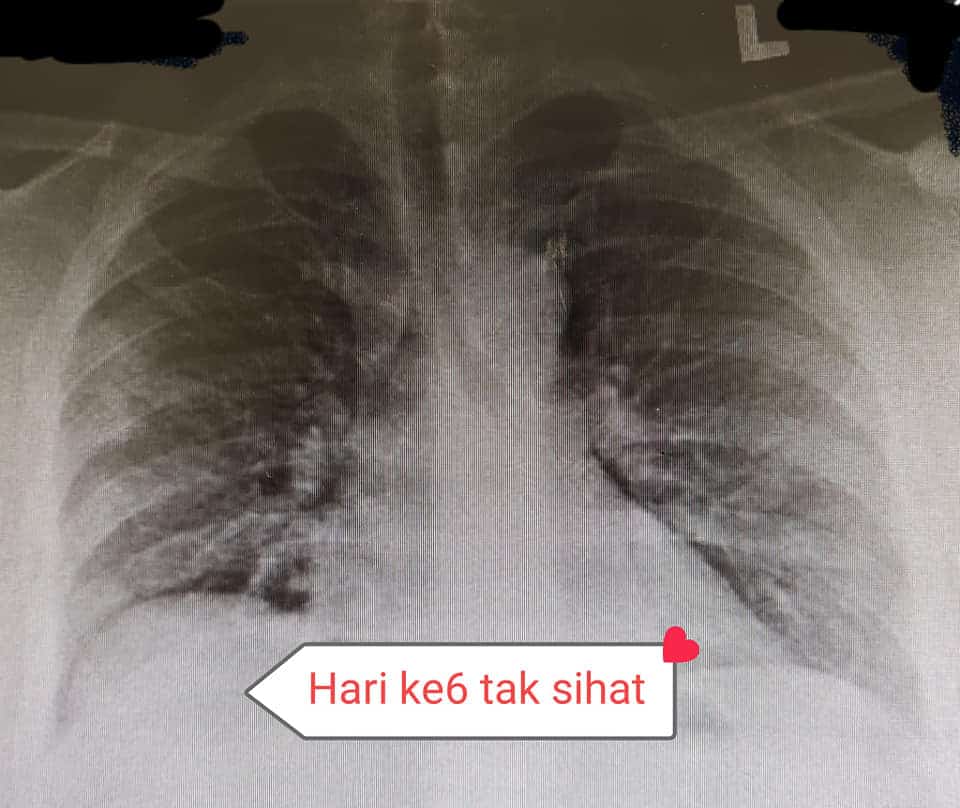 Suami Tak Percaya COVID-19, Telan ‘Bergelen’ Vitamin C Kini Isteri Sedang Nazak