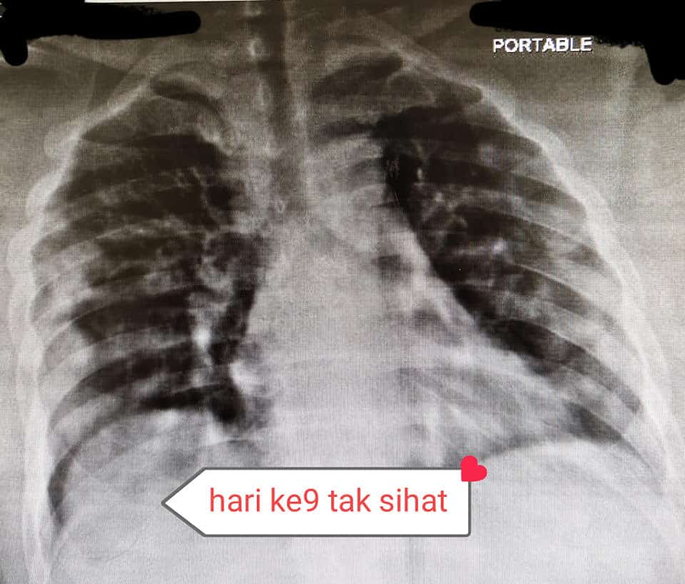 Suami Tak Percaya COVID-19, Telan ‘Bergelen’ Vitamin C Kini Isteri Sedang Nazak